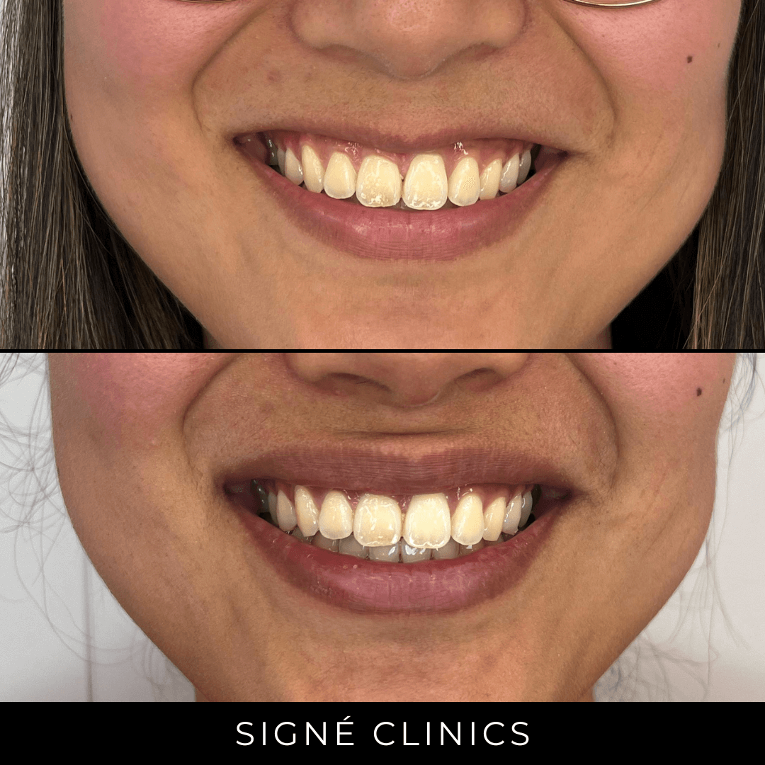 lipflip signe clinics