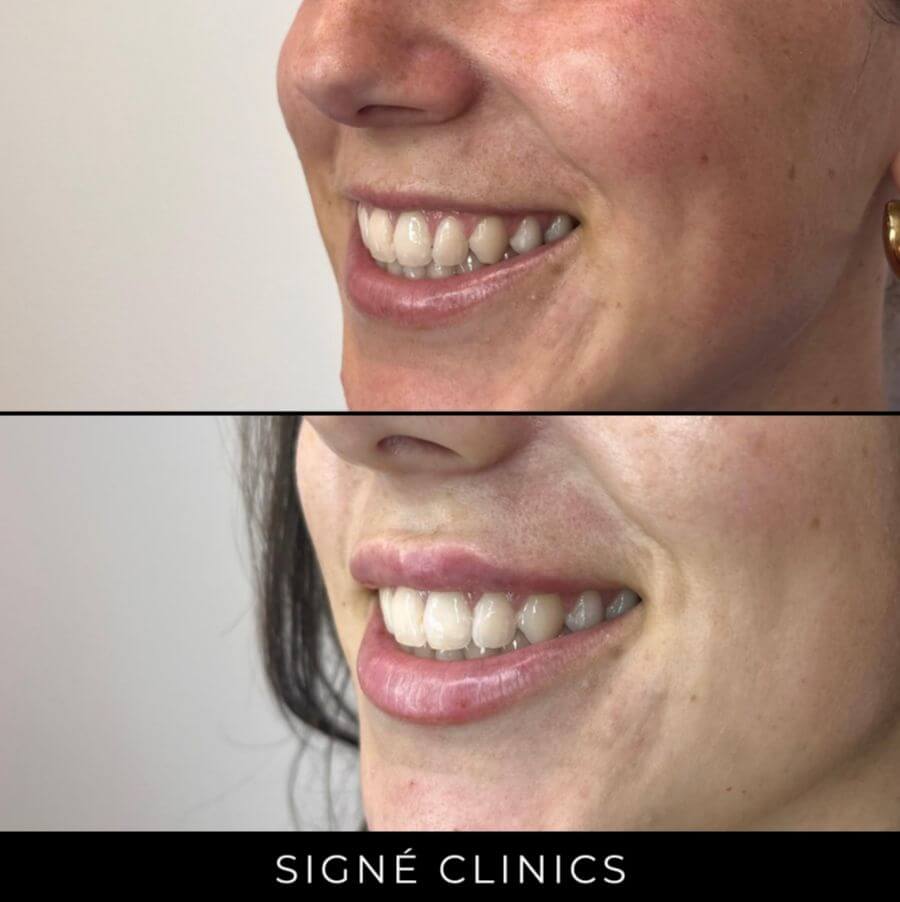 lipfillers signe clinics