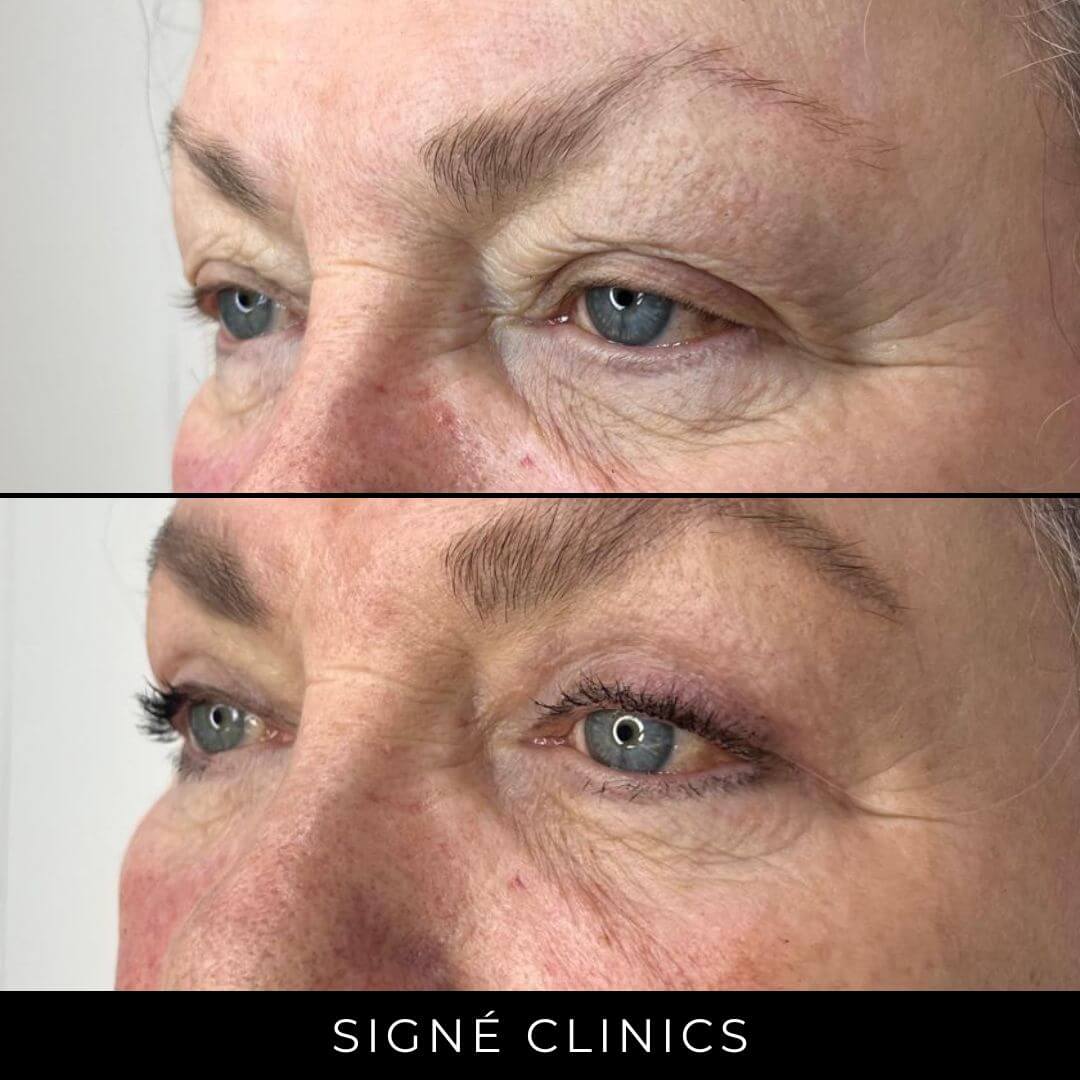 ooglidcorrectie signe clinics