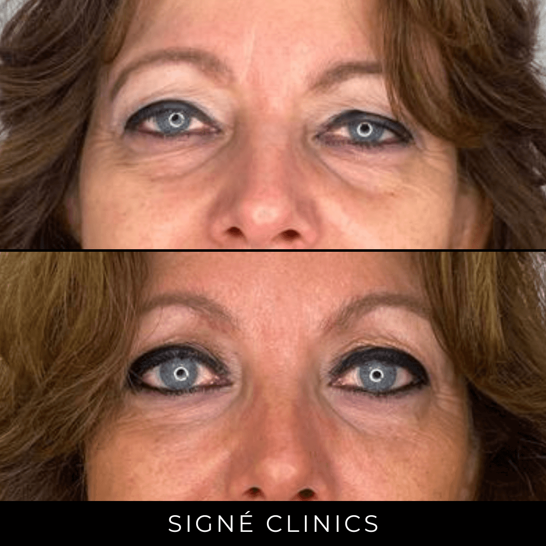 resultaten ooglidcorrectie signe clincis