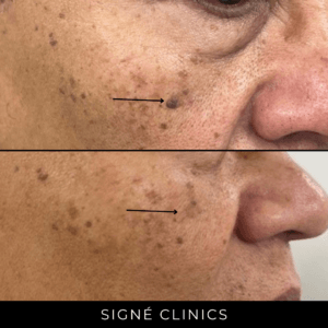 Verrucae Seborrhocia  ouderdom Wratten  met Das Plasma