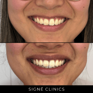 lipflip signe clinics