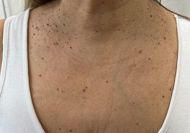 Ouderdomswrat behandeling